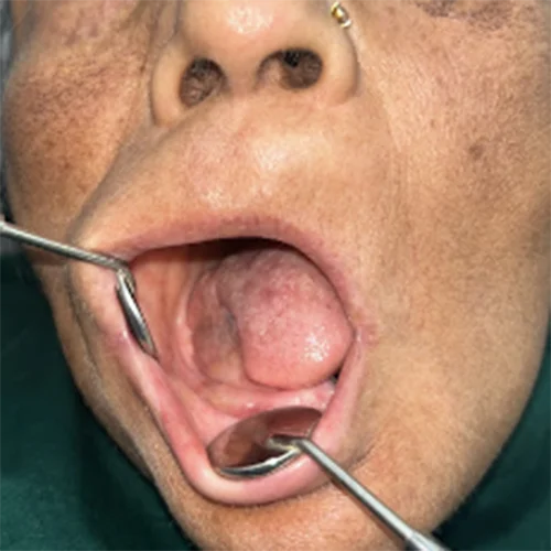 Patient after oral surgery treatment