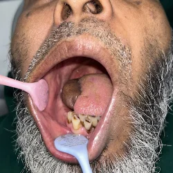 Patient after oral surgery treatment