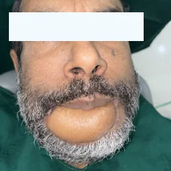 Patient after oral surgery treatment